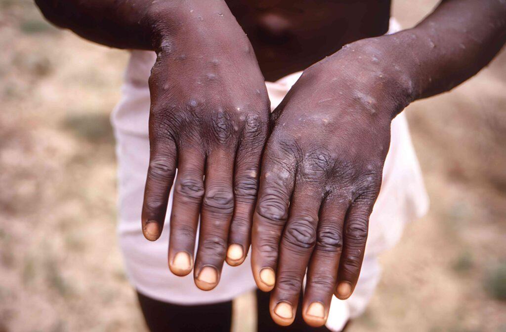 Alarming Mpox Surge: Children in DRC and Burundi Face Deadly New Strain Amid Healthcare Crisis