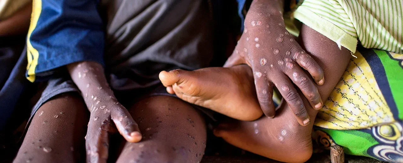 Alarming Mpox Surge: Children in DRC and Burundi Face Deadly New Strain Amid Healthcare Crisis