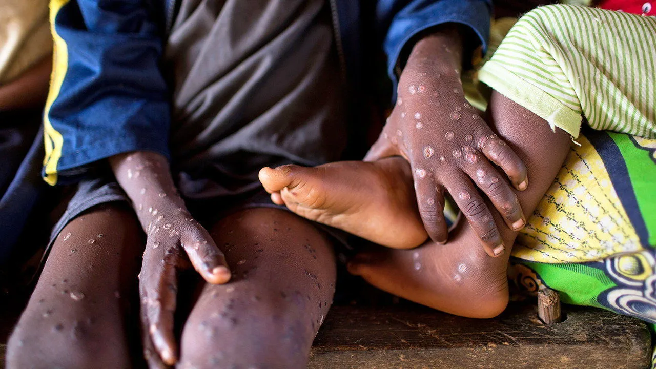 Alarming Mpox Surge: Children in DRC and Burundi Face Deadly New Strain Amid Healthcare Crisis