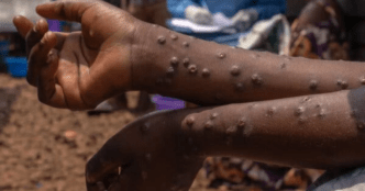 Sierra Leone Confirms First Mpox Case Since WHO Global Alert