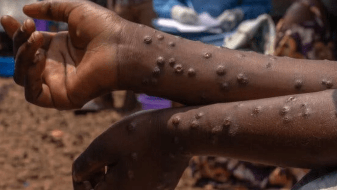 Sierra Leone Confirms First Mpox Case Since WHO Global Alert