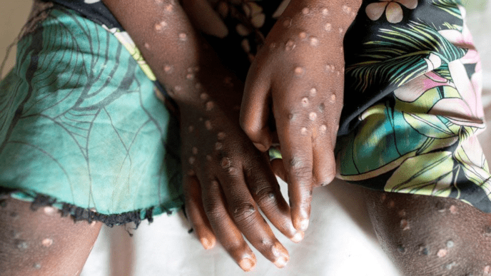 WHO Raises Concerns as Mpox Cases Hit 14,700 in Africa